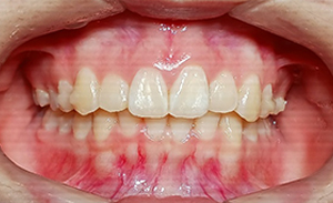 case13-b