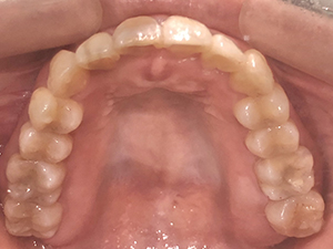 case14-aftre2