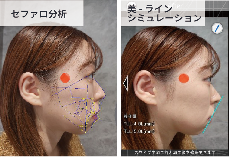 セファロと美－ラインの比較
