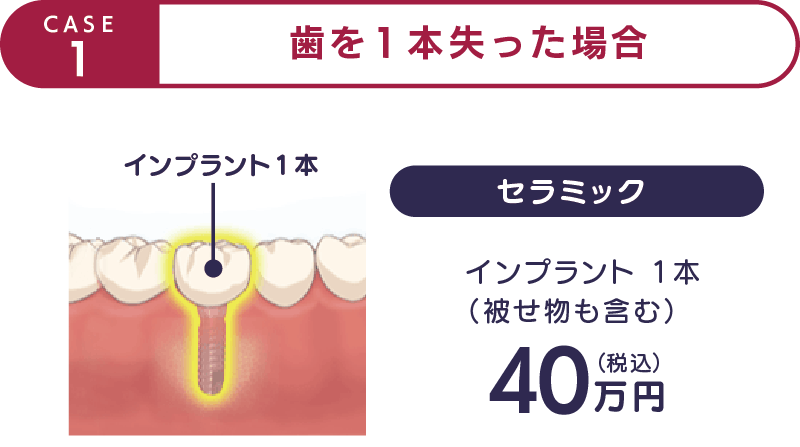 CASE1-歯を1本失った場合-セラミック40万