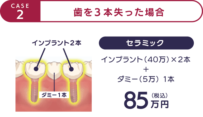 CASE2-歯を3本失った場合-セラミック85万