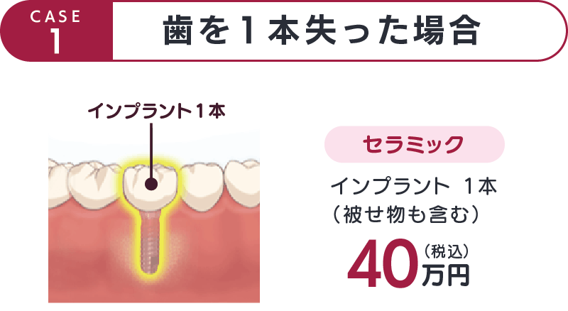 CASE1-歯を1本失った場合-セラミック40万
