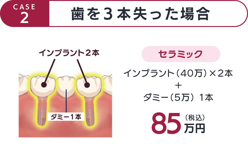 CASE2-歯を3本失った場合-セラミック85万